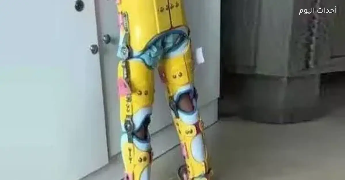 التعليم العالي بتفكر في إنشاء أول مستشفى جامعي للأطراف الصناعية والأجهزة التقويمية