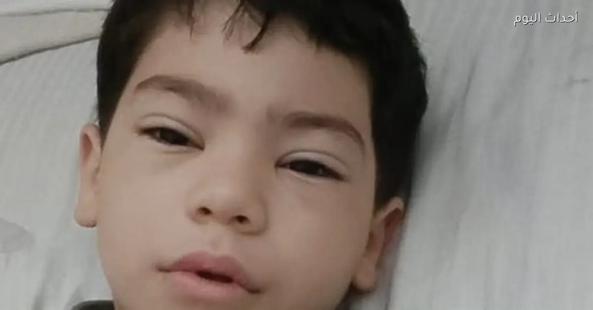 معهد ناصر ينقذ ساق طفل من البتر بعد 12 ساعة جراحة