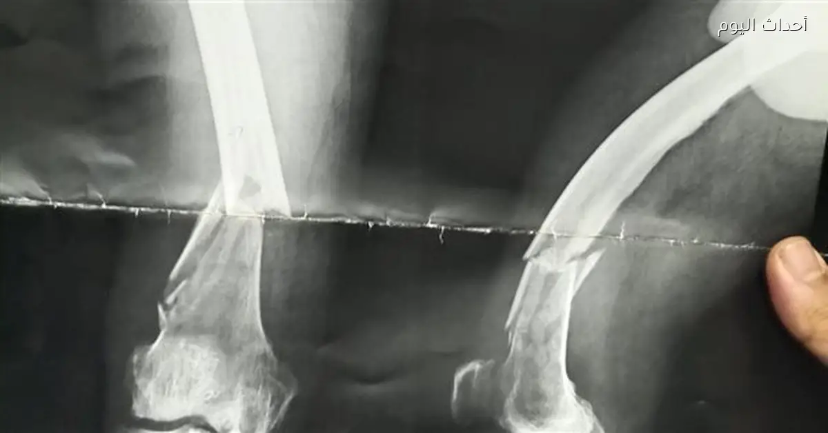 نجاح عمليتين معقدتين في قسم العظام بمستشفى قنا العام