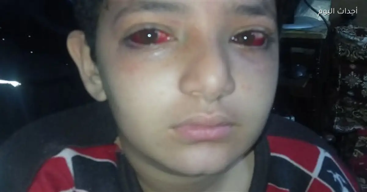 مطالبات بمحاسبة مسؤولين بعد إصابة طالب في عينه داخل مدرسة