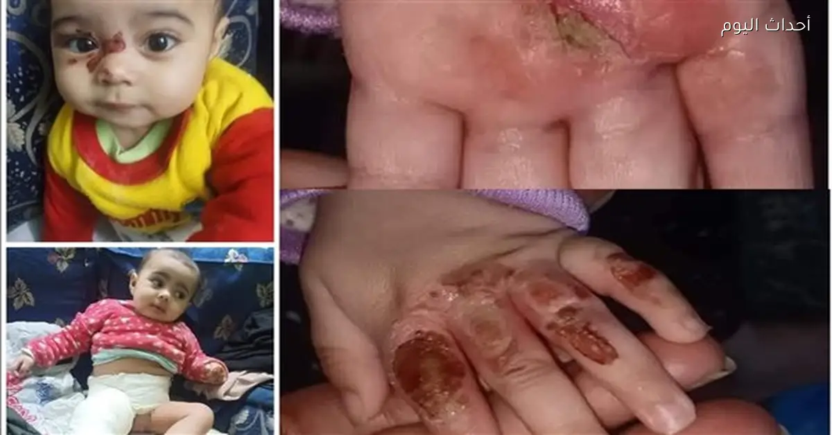 أم تحرق رضيعتها بالمعلقة وتكسر قدمها في إمبابة